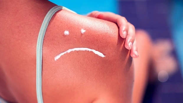 Iceskin bị cháy nắng